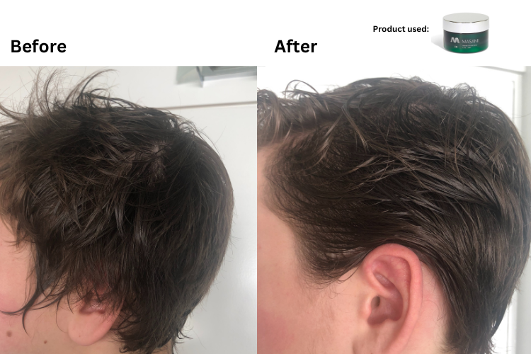 Before and after comparison of hair growth with a product container labeled 'Minoxidil' 