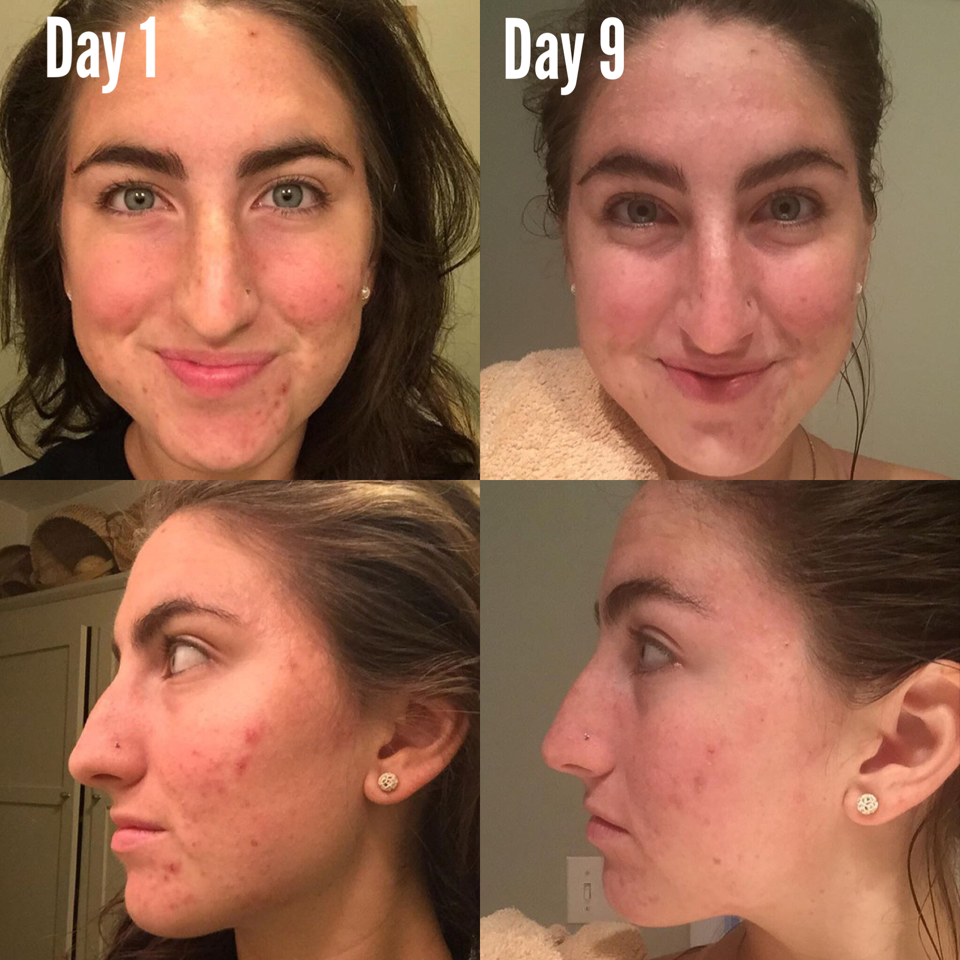 Before and after comparison of a woman's face with acne on Day 1 and Day 9.