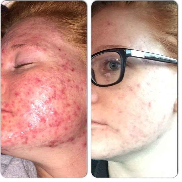 Before and after comparison of a person's face with acne on the left and clear skin on the right.
