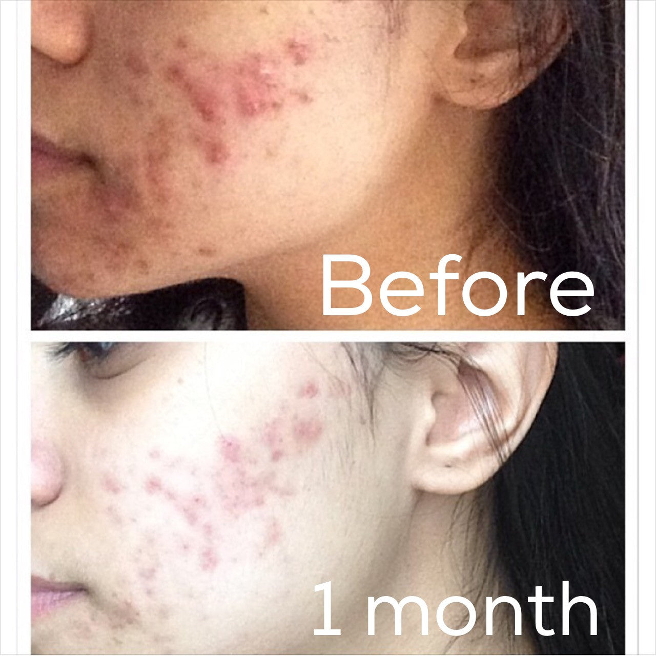 Before and after comparison of acne on a person's face with 'Before' and '1 month' labels.